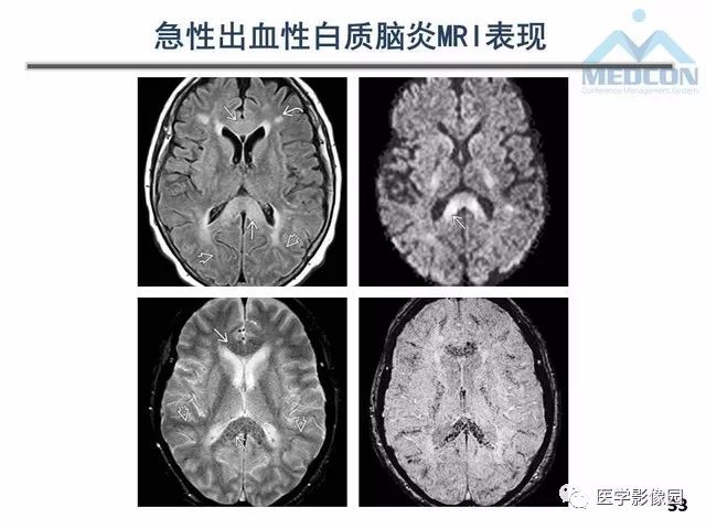 【PPT】MR在MS诊断与鉴别诊断中的价值