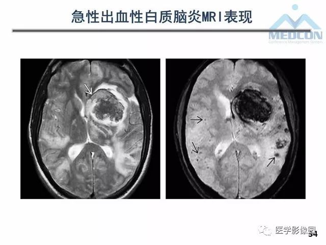【PPT】MR在MS诊断与鉴别诊断中的价值
