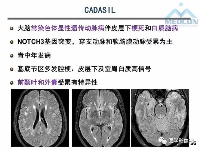 【PPT】MR在MS诊断与鉴别诊断中的价值