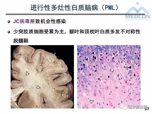 【PPT】MR在MS诊断与鉴别诊断中的价值