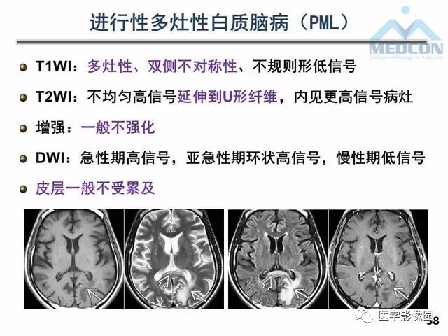 【PPT】MR在MS诊断与鉴别诊断中的价值