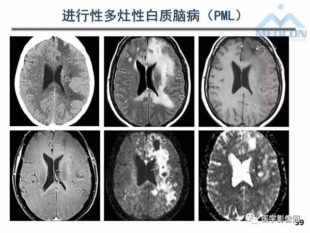 【PPT】MR在MS诊断与鉴别诊断中的价值