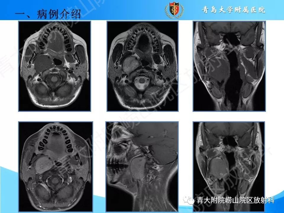 【PPT】颈动脉间隙占位性病变的影像鉴别诊断