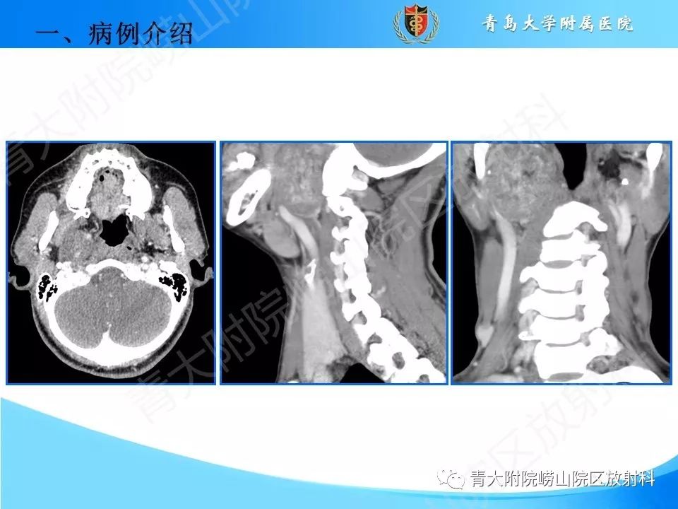 【PPT】颈动脉间隙占位性病变的影像鉴别诊断