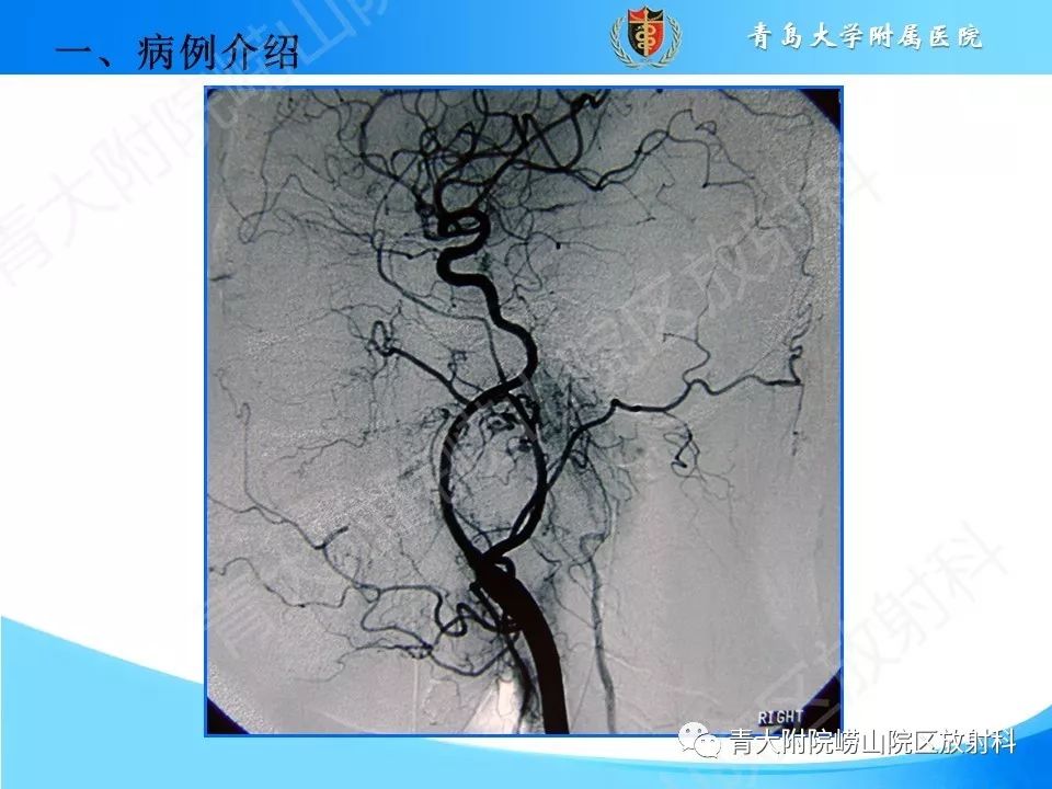 【PPT】颈动脉间隙占位性病变的影像鉴别诊断