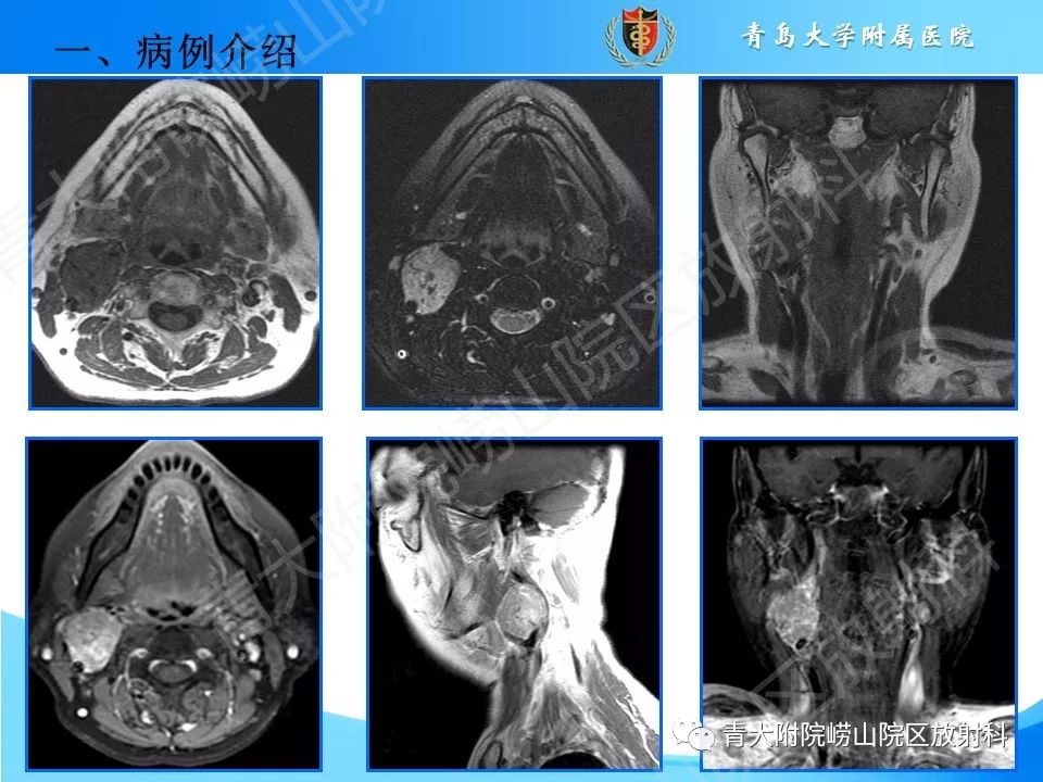 【PPT】颈动脉间隙占位性病变的影像鉴别诊断