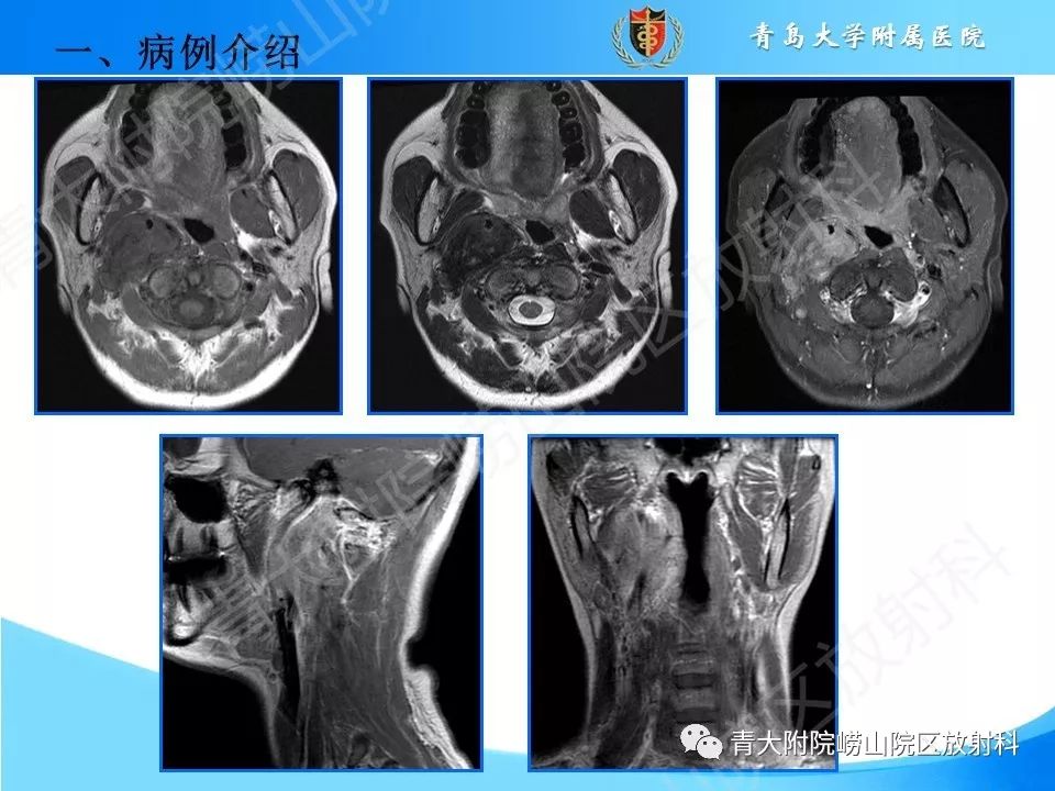 【PPT】颈动脉间隙占位性病变的影像鉴别诊断