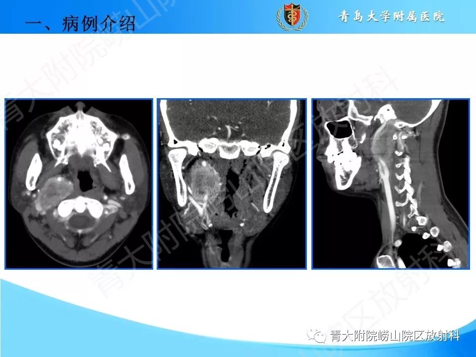 【PPT】颈动脉间隙占位性病变的影像鉴别诊断