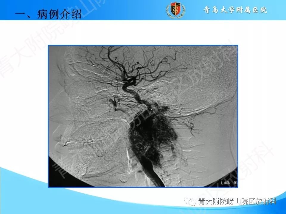 【PPT】颈动脉间隙占位性病变的影像鉴别诊断