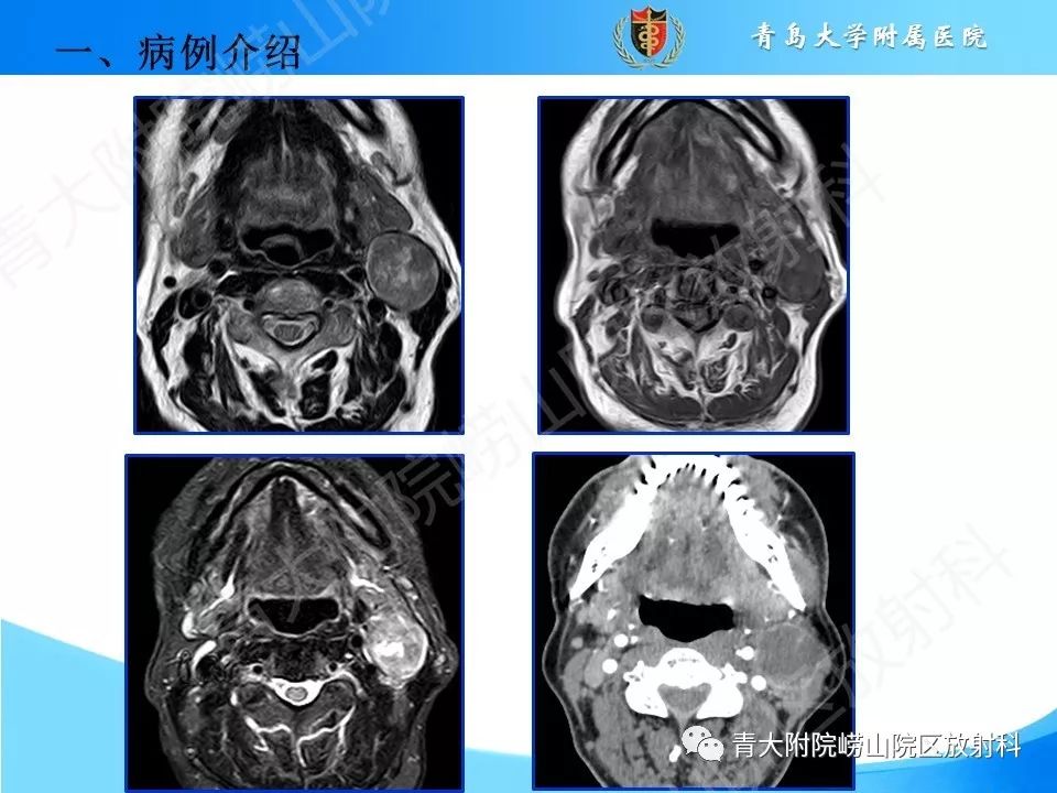 【PPT】颈动脉间隙占位性病变的影像鉴别诊断