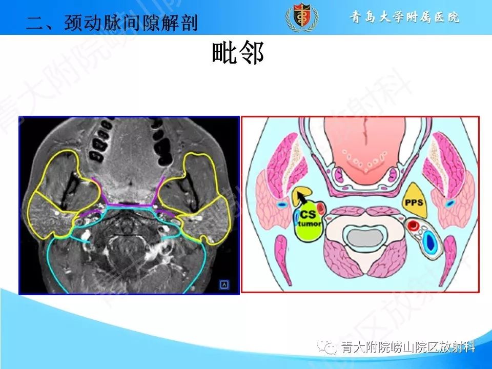 【PPT】颈动脉间隙占位性病变的影像鉴别诊断