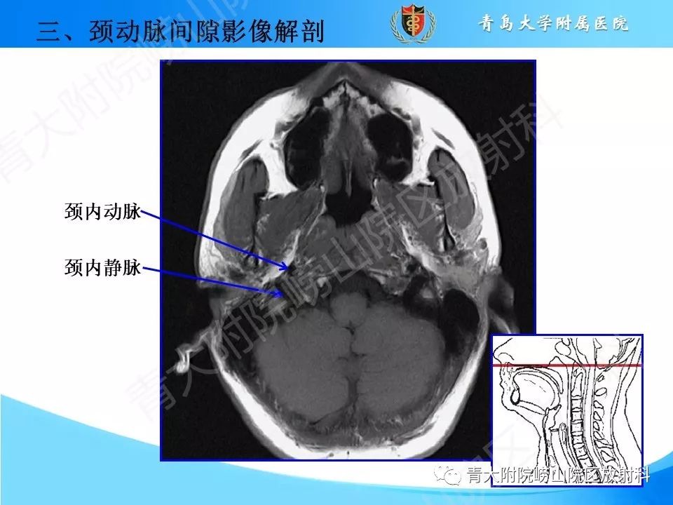 【PPT】颈动脉间隙占位性病变的影像鉴别诊断