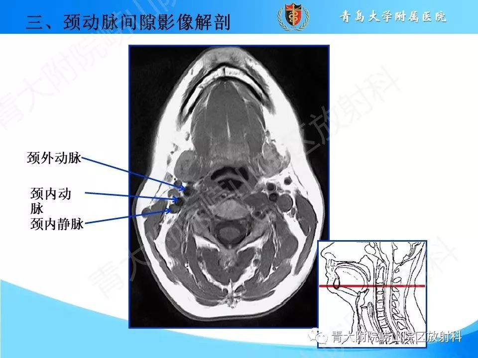 【PPT】颈动脉间隙占位性病变的影像鉴别诊断