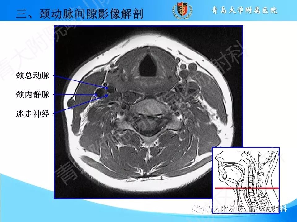 【PPT】颈动脉间隙占位性病变的影像鉴别诊断