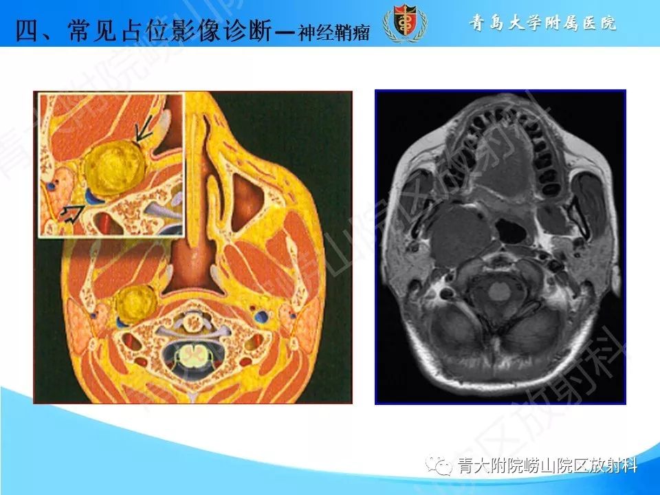 【PPT】颈动脉间隙占位性病变的影像鉴别诊断