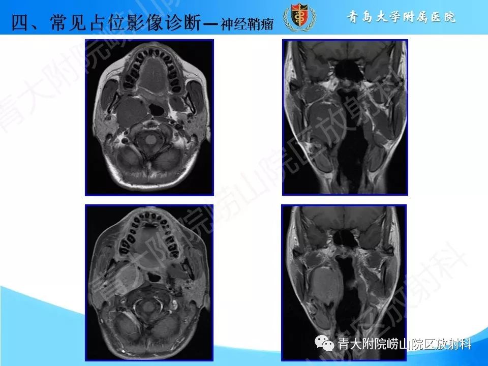【PPT】颈动脉间隙占位性病变的影像鉴别诊断