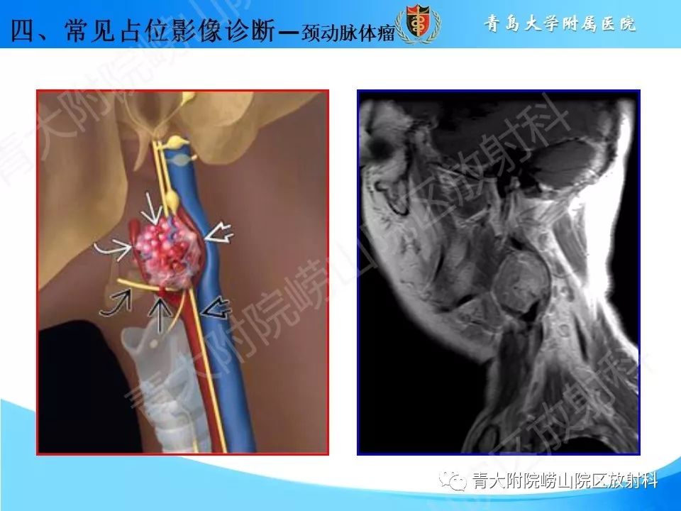 【PPT】颈动脉间隙占位性病变的影像鉴别诊断