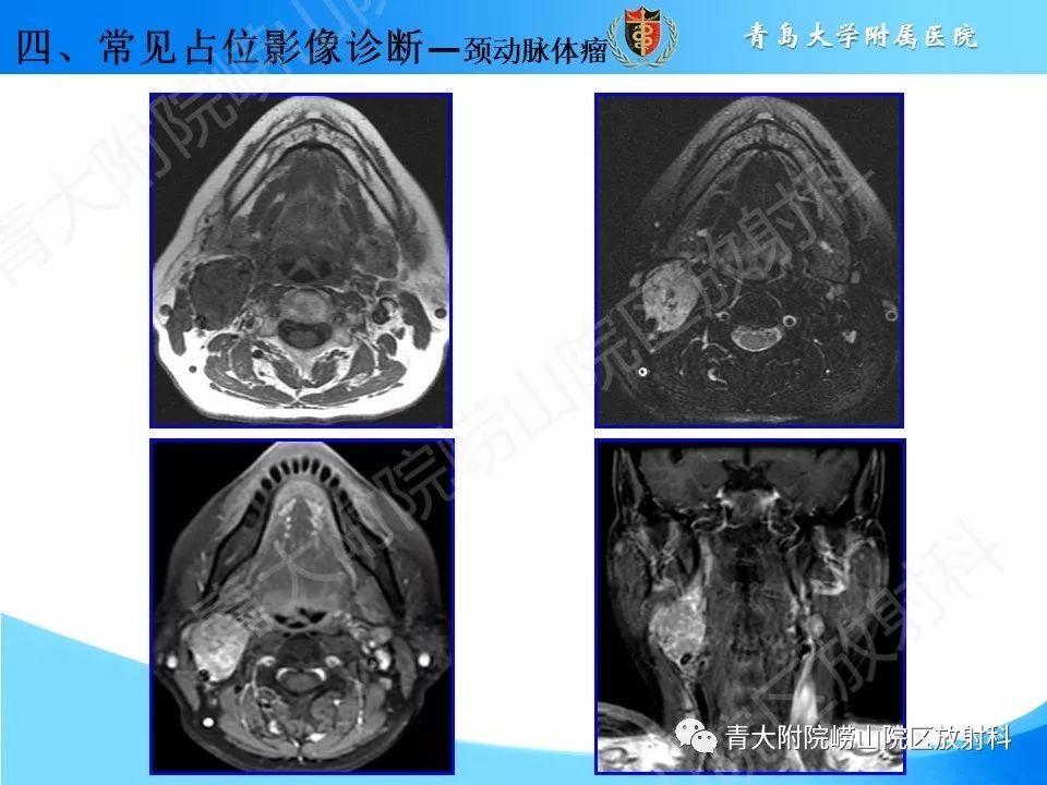 【PPT】颈动脉间隙占位性病变的影像鉴别诊断