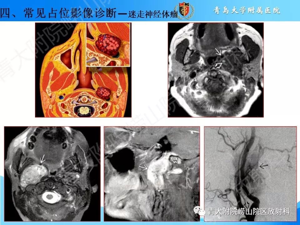 【PPT】颈动脉间隙占位性病变的影像鉴别诊断