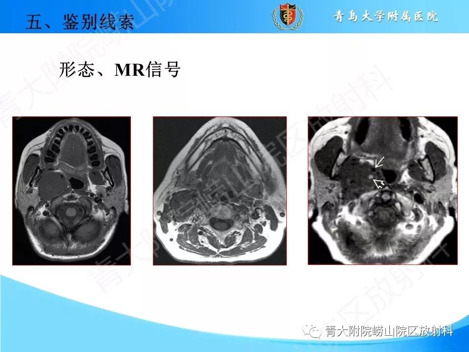 【PPT】颈动脉间隙占位性病变的影像鉴别诊断