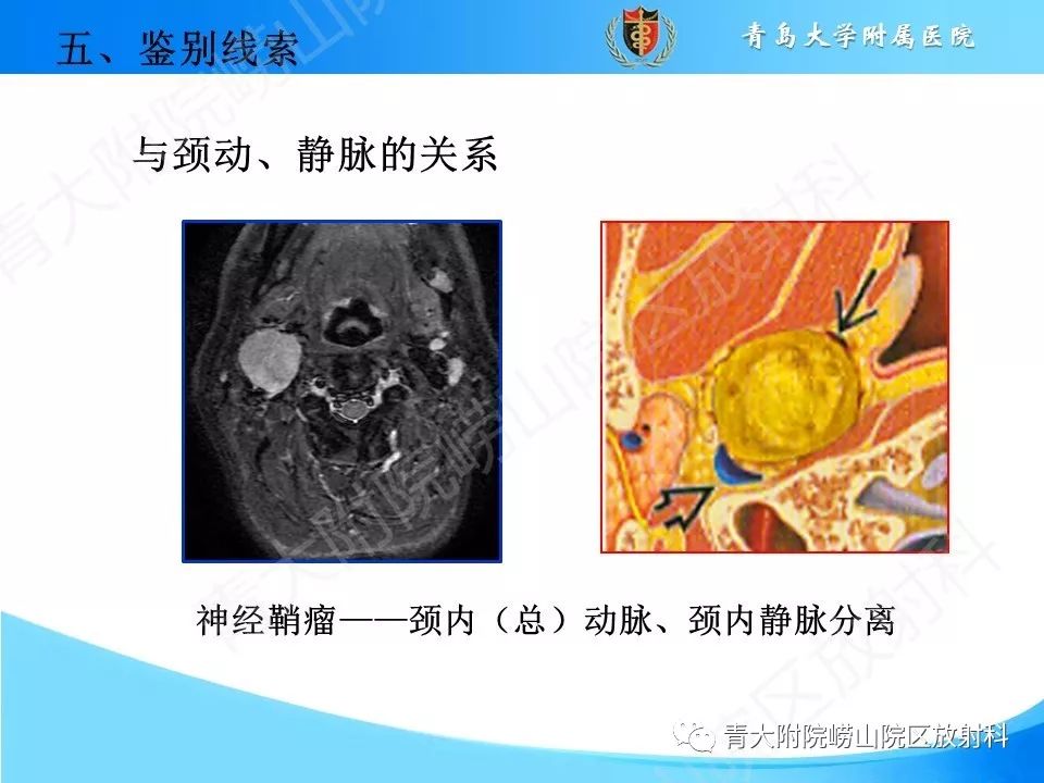【PPT】颈动脉间隙占位性病变的影像鉴别诊断