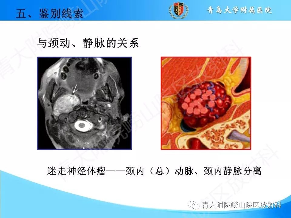 【PPT】颈动脉间隙占位性病变的影像鉴别诊断