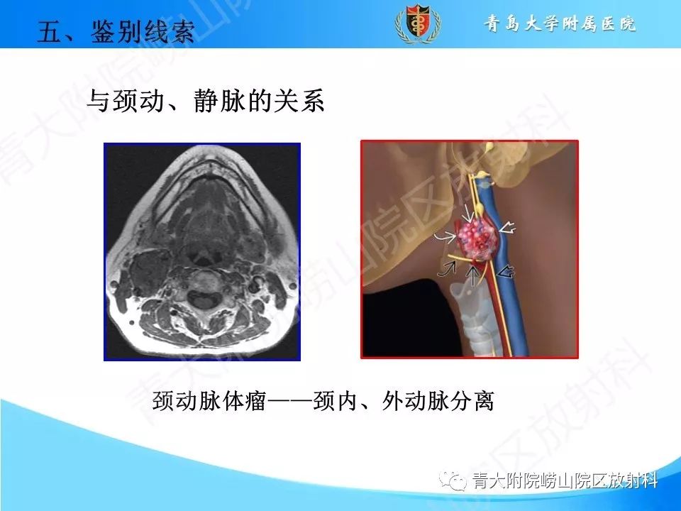 【PPT】颈动脉间隙占位性病变的影像鉴别诊断