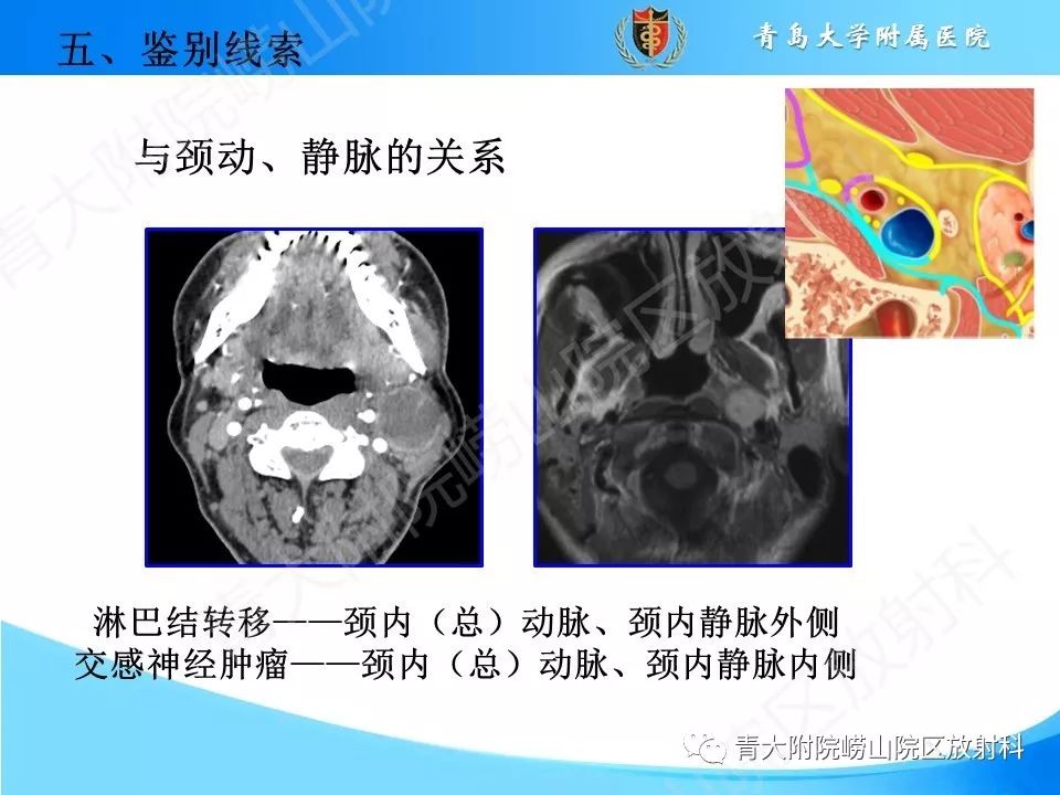 【PPT】颈动脉间隙占位性病变的影像鉴别诊断