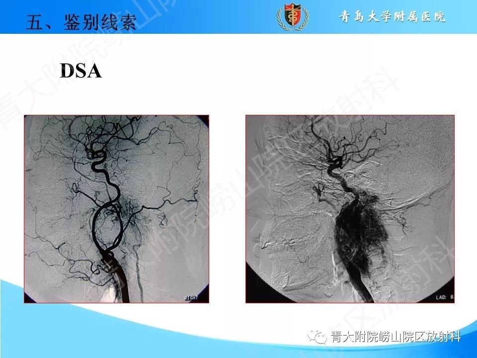 【PPT】颈动脉间隙占位性病变的影像鉴别诊断