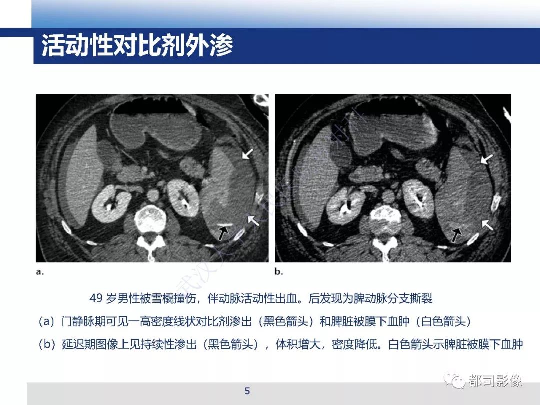 【PPT】腹盆腔血管钝性创伤CT表现