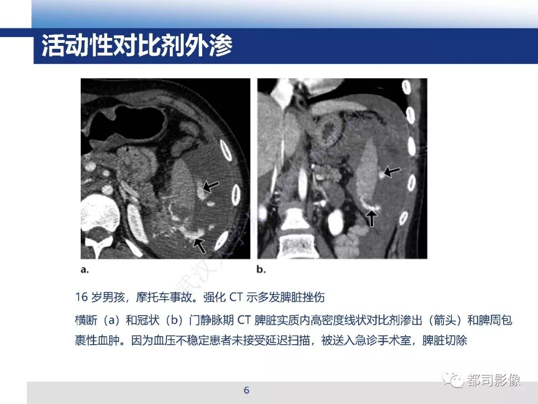 【PPT】腹盆腔血管钝性创伤CT表现