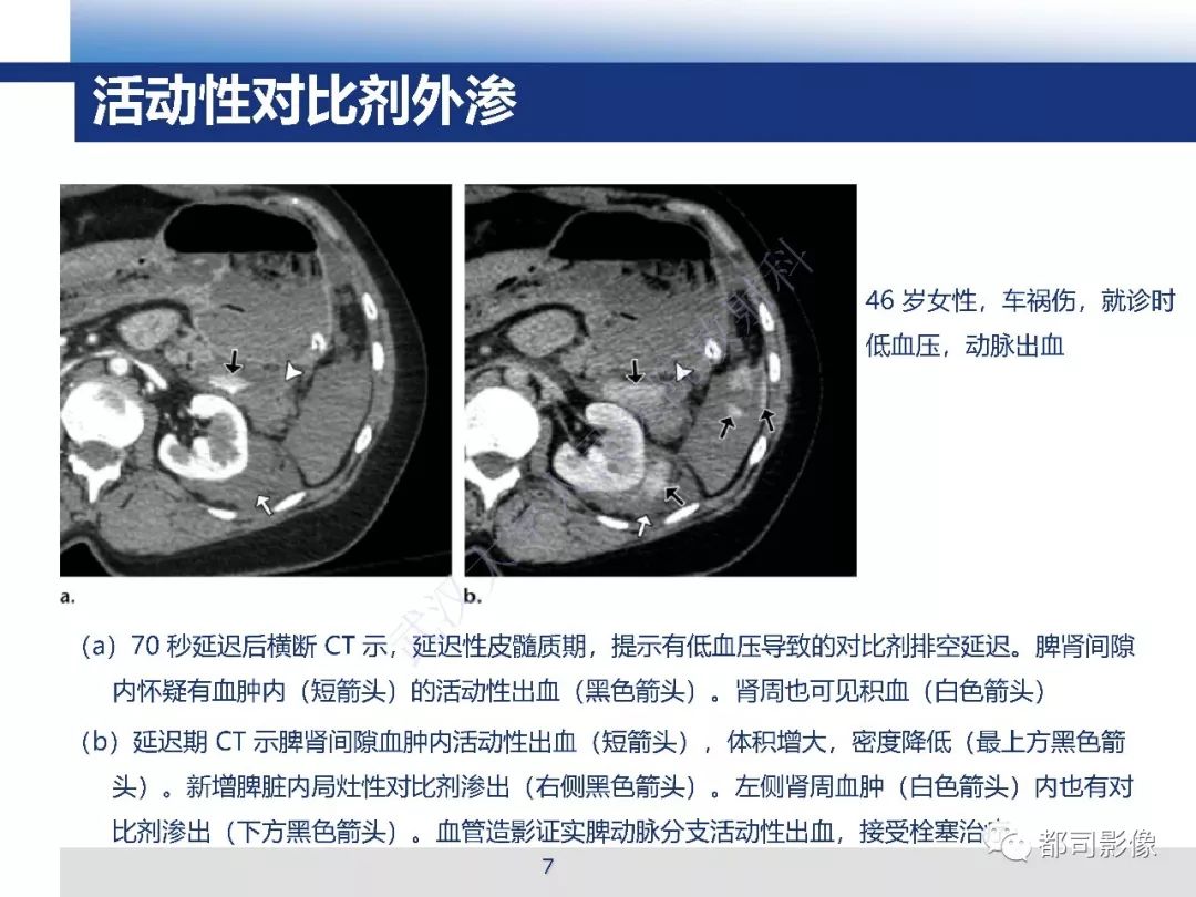 【PPT】腹盆腔血管钝性创伤CT表现
