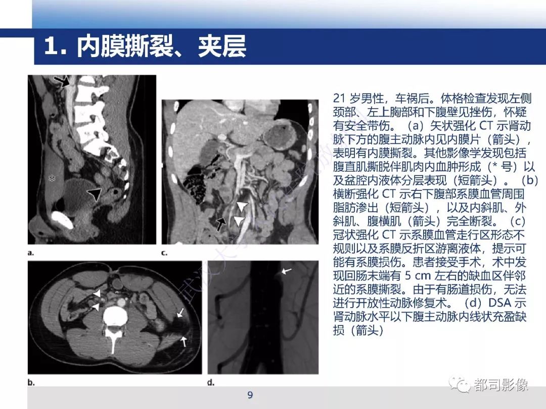 【PPT】腹盆腔血管钝性创伤CT表现