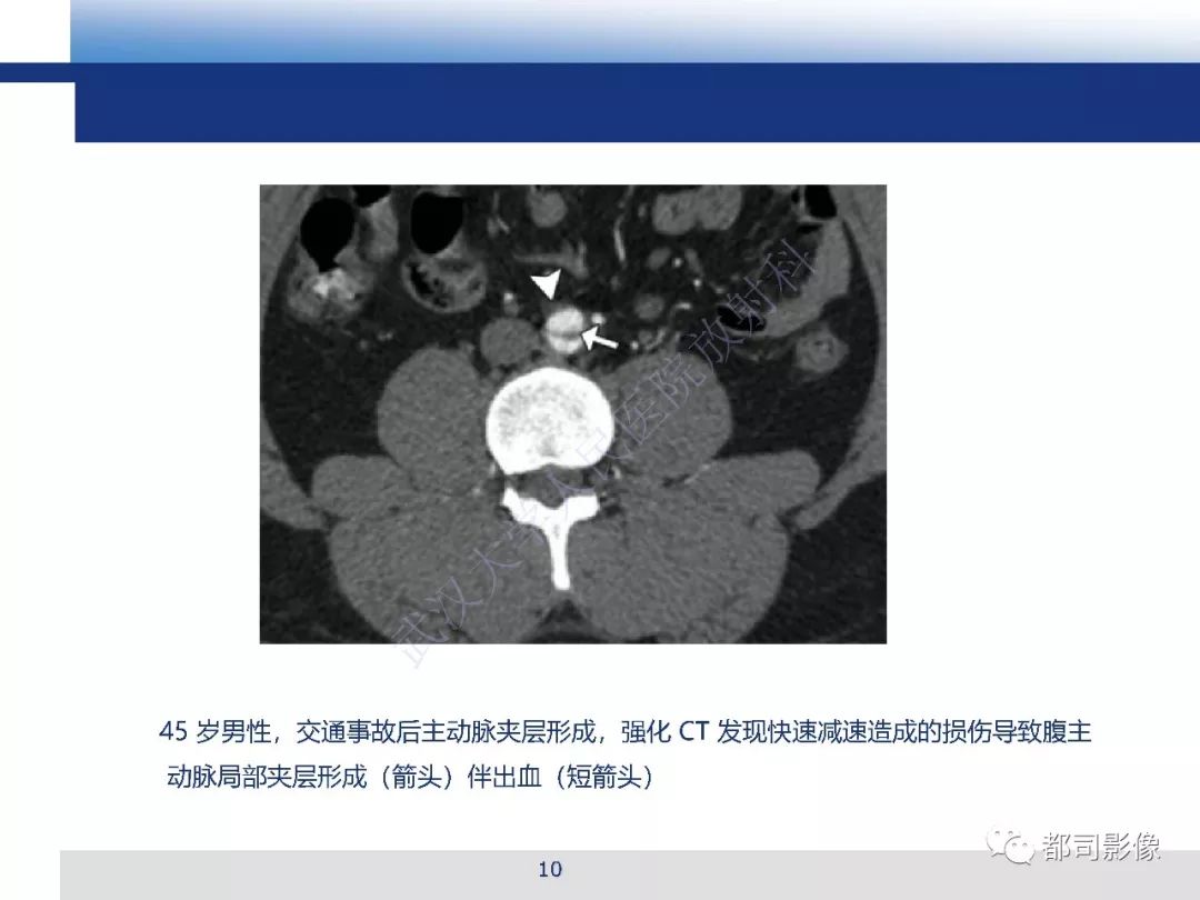 【PPT】腹盆腔血管钝性创伤CT表现