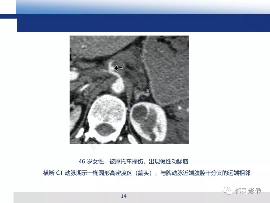 【PPT】腹盆腔血管钝性创伤CT表现