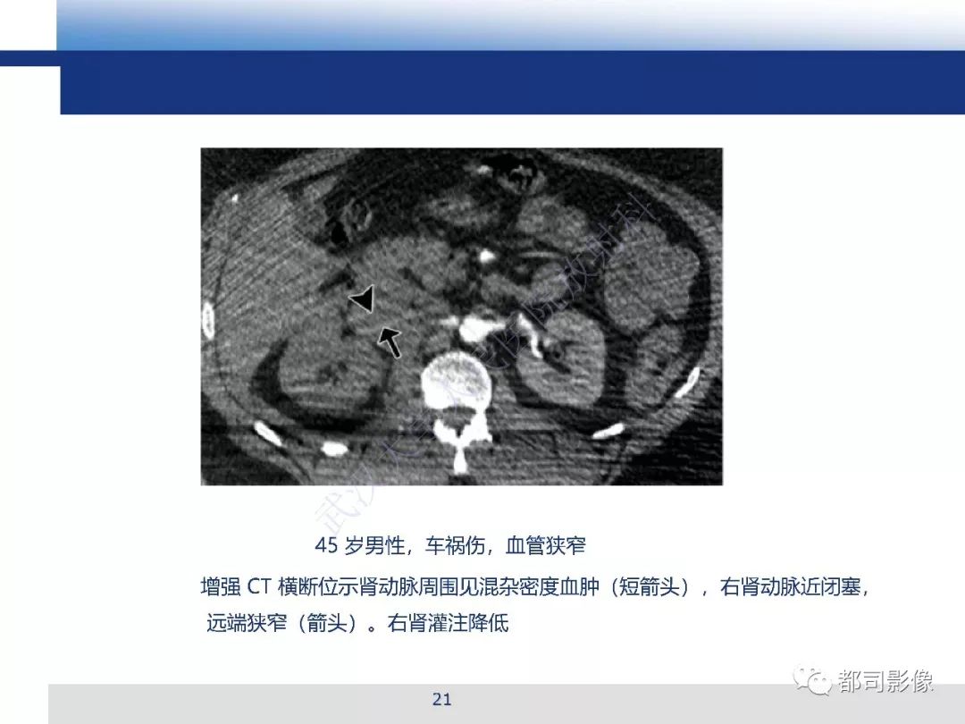 【PPT】腹盆腔血管钝性创伤CT表现