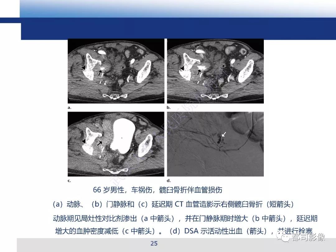 【PPT】腹盆腔血管钝性创伤CT表现