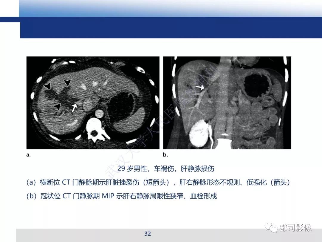 【PPT】腹盆腔血管钝性创伤CT表现