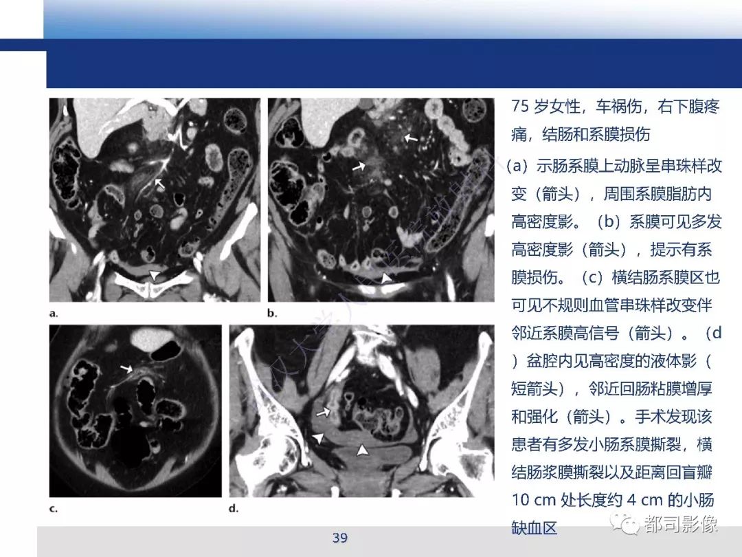 【PPT】腹盆腔血管钝性创伤CT表现