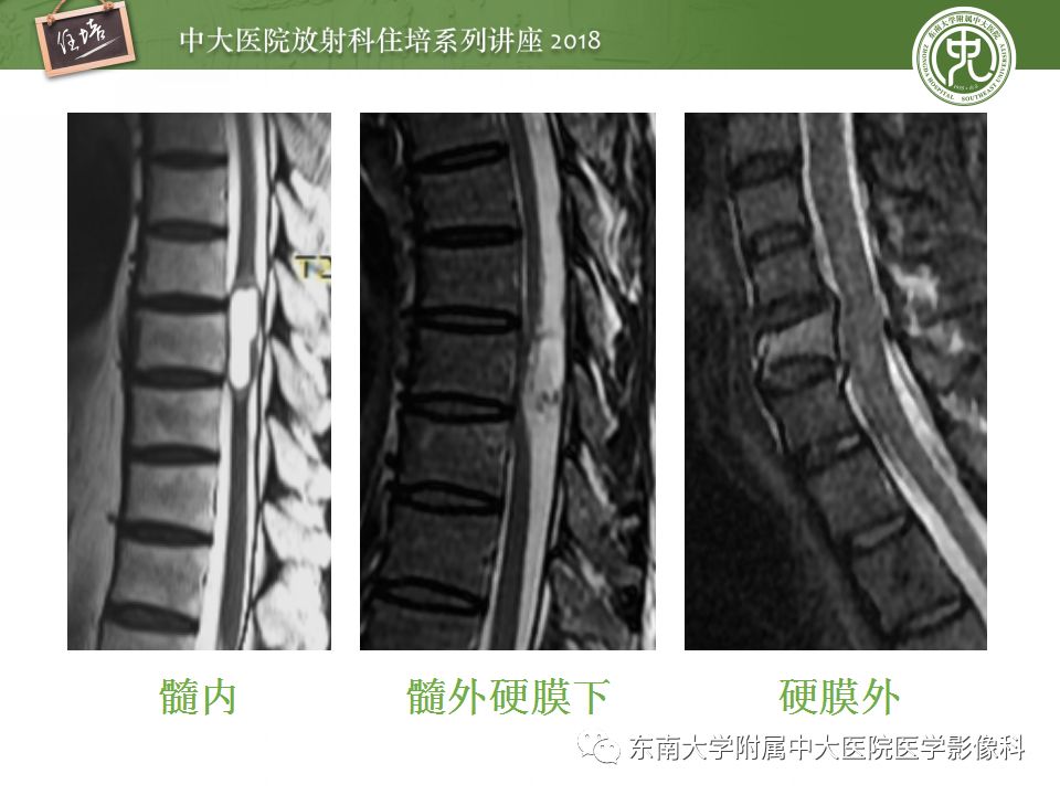 【PPT】脊髓内常见疾病的MR诊断