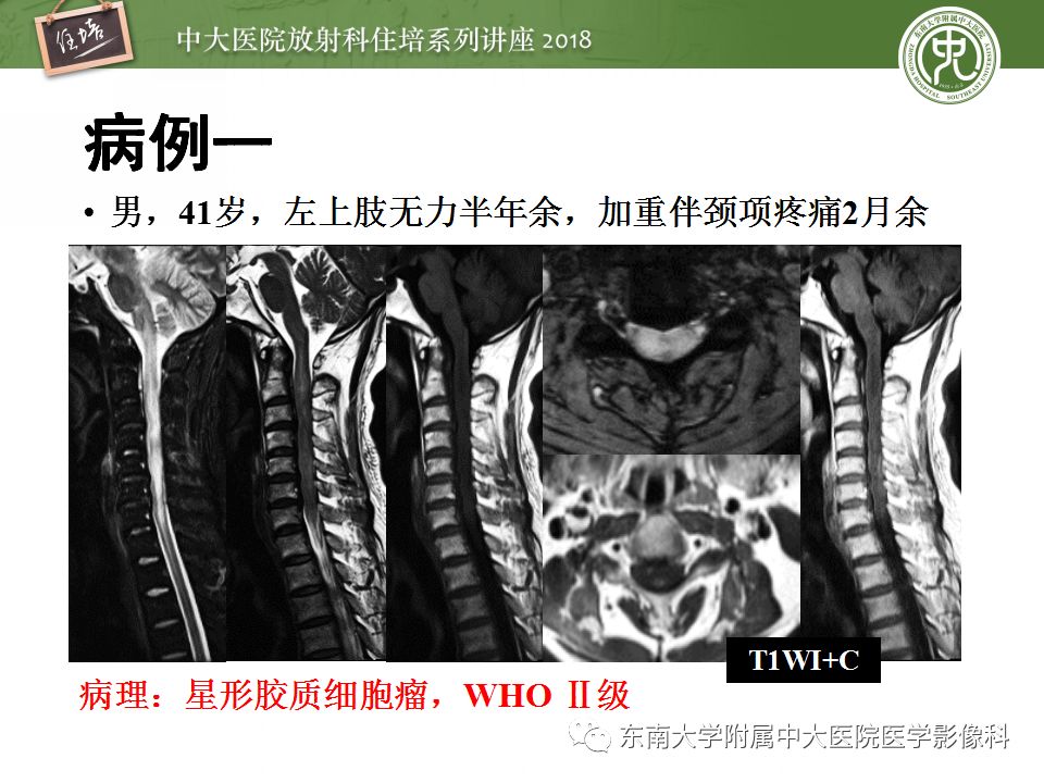 【PPT】脊髓内常见疾病的MR诊断