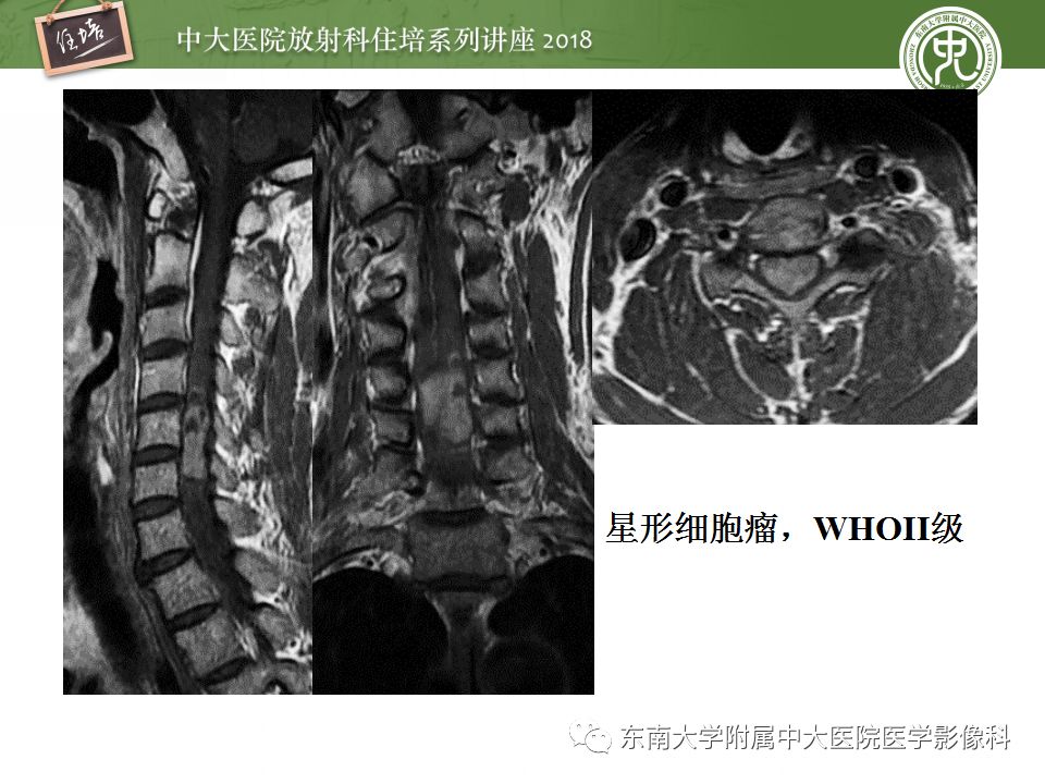 【PPT】脊髓内常见疾病的MR诊断