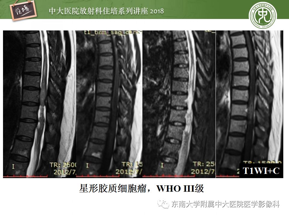 【PPT】脊髓内常见疾病的MR诊断