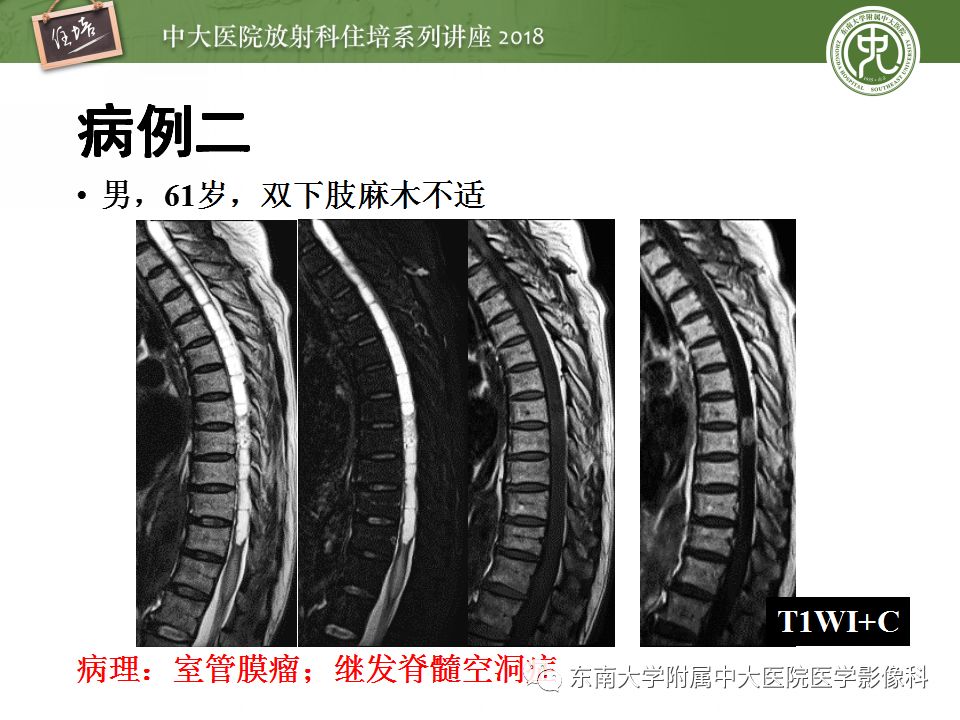 【PPT】脊髓内常见疾病的MR诊断