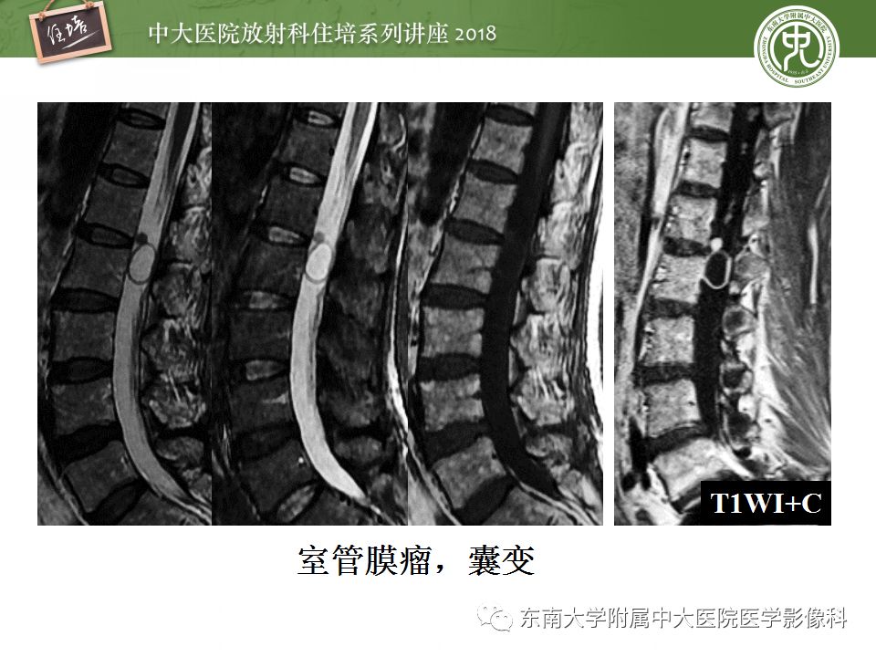 【PPT】脊髓内常见疾病的MR诊断