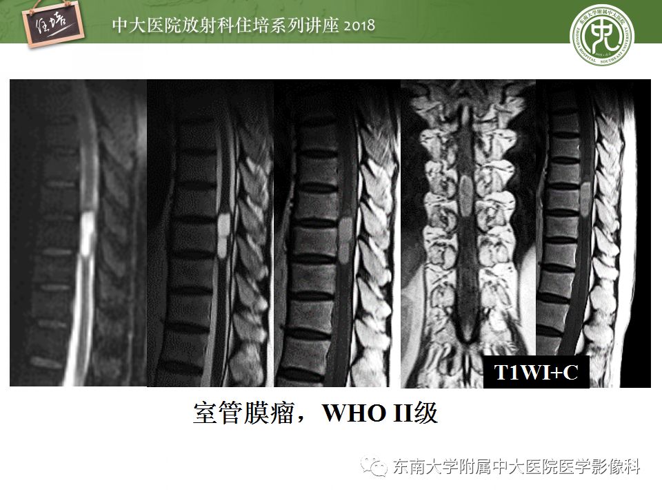 【PPT】脊髓内常见疾病的MR诊断
