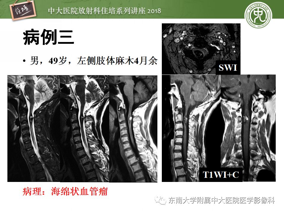 【PPT】脊髓内常见疾病的MR诊断