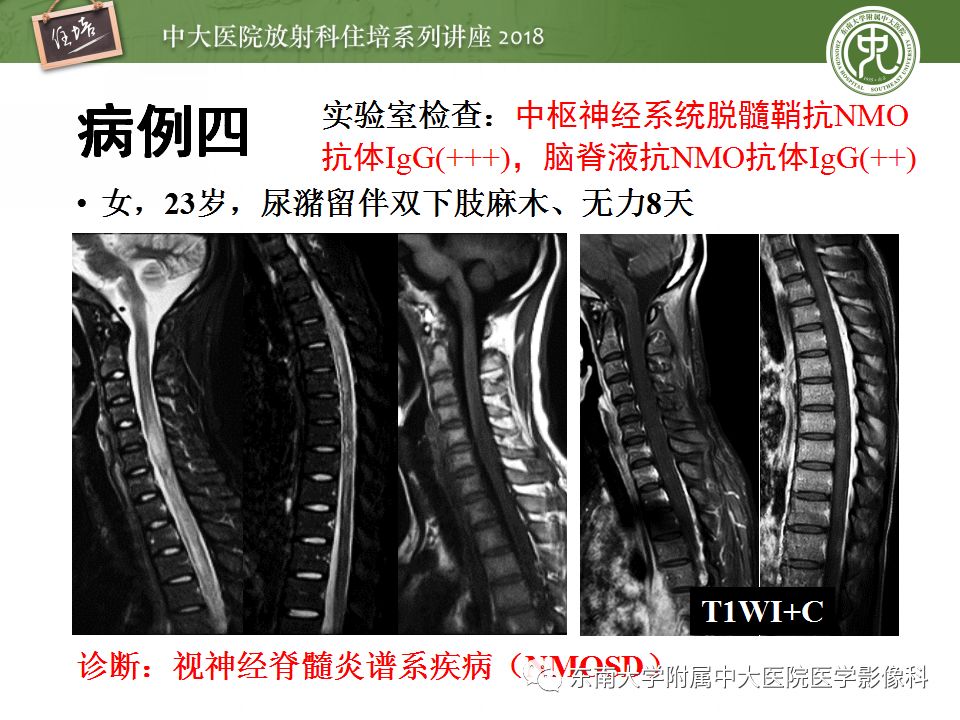 【PPT】脊髓内常见疾病的MR诊断