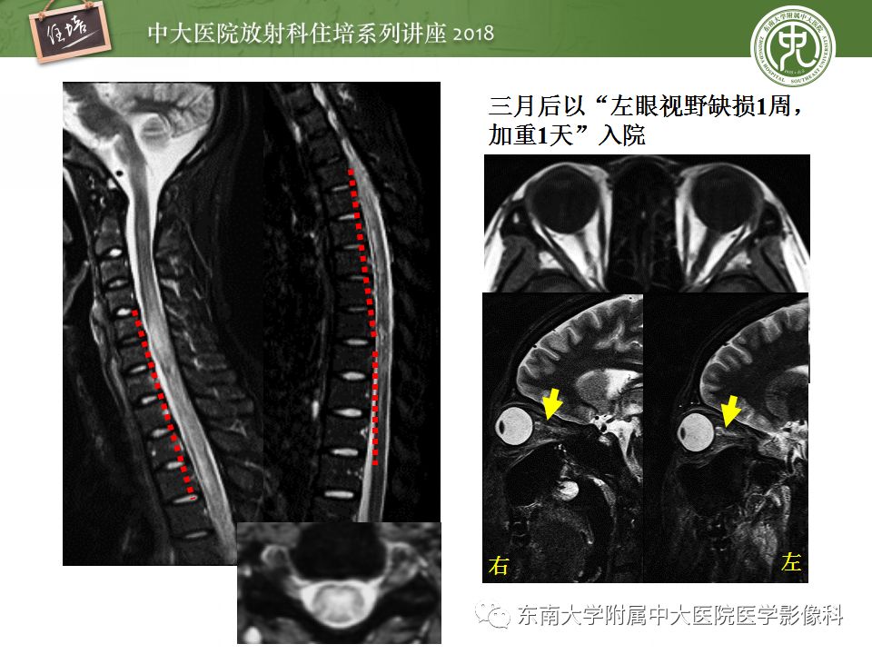【PPT】脊髓内常见疾病的MR诊断
