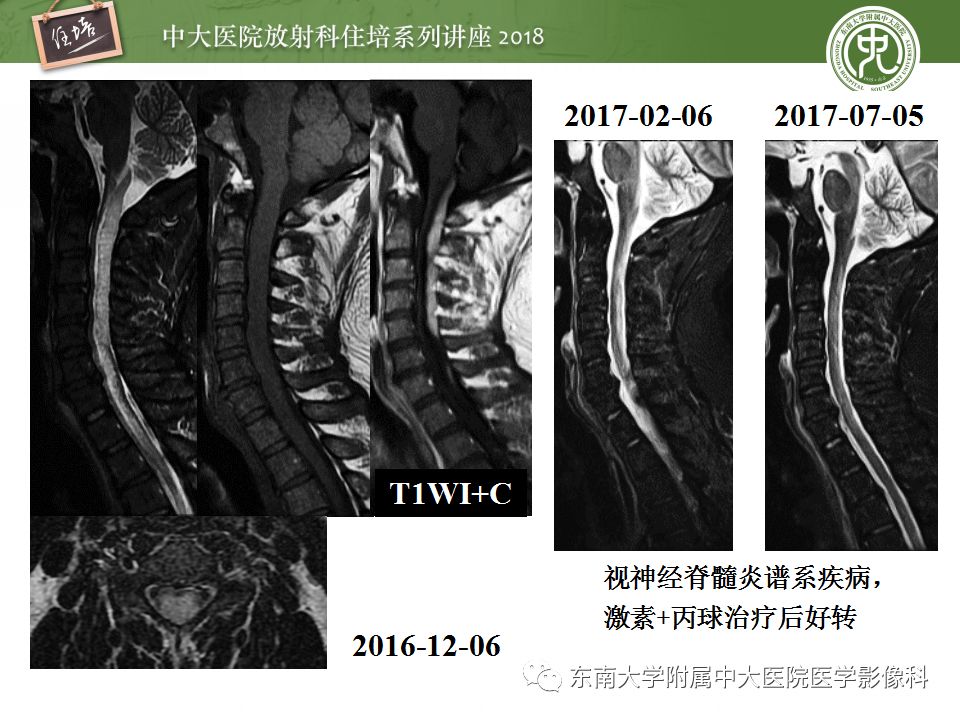 【PPT】脊髓内常见疾病的MR诊断